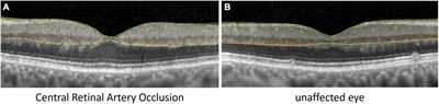 Inner Retinal Layer Hyperreflectivity Is an Early Biomarker for Acute Central Retinal Artery Occlusion